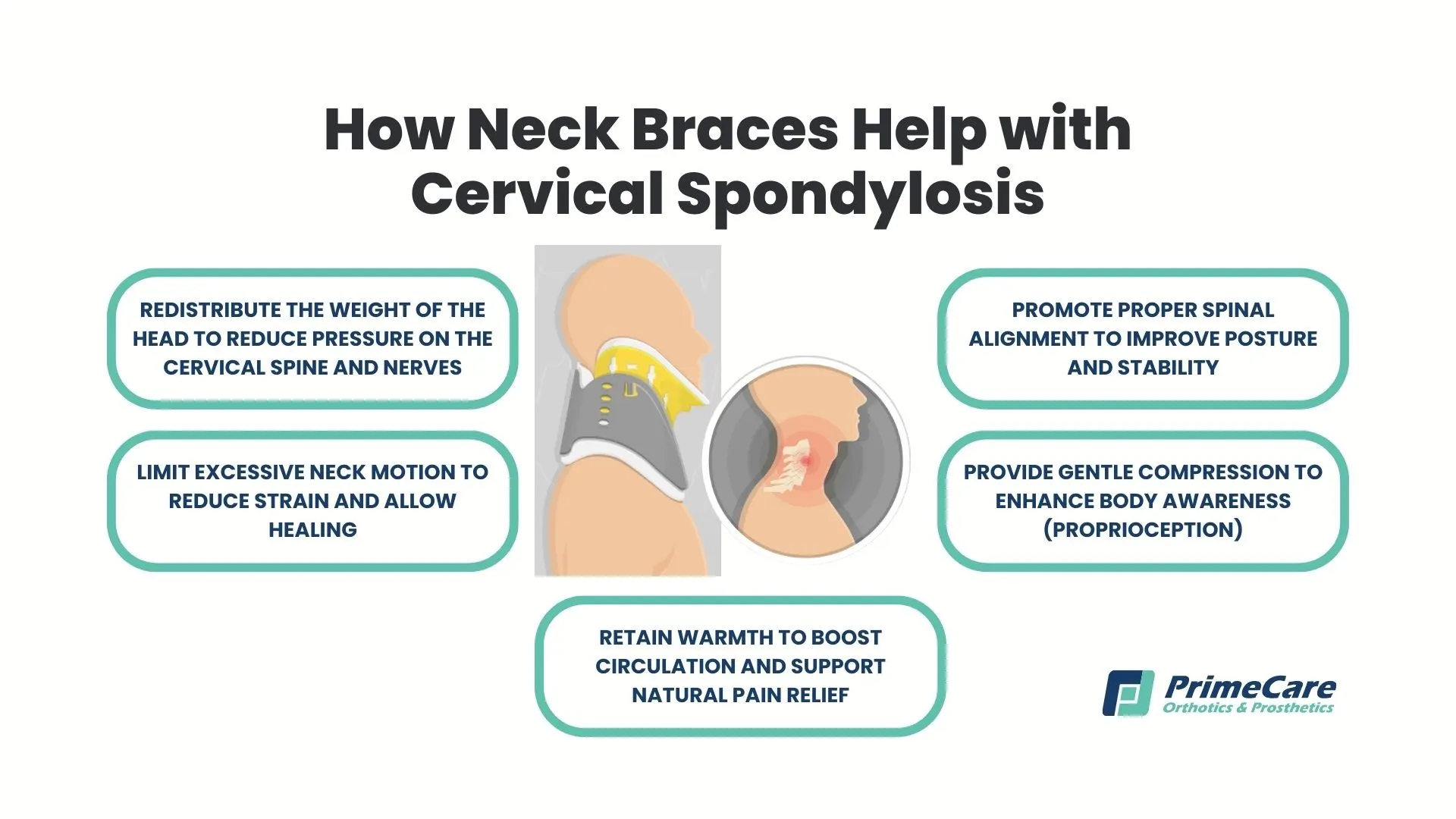 How Neck Braces Help with Cervical Spondylosis