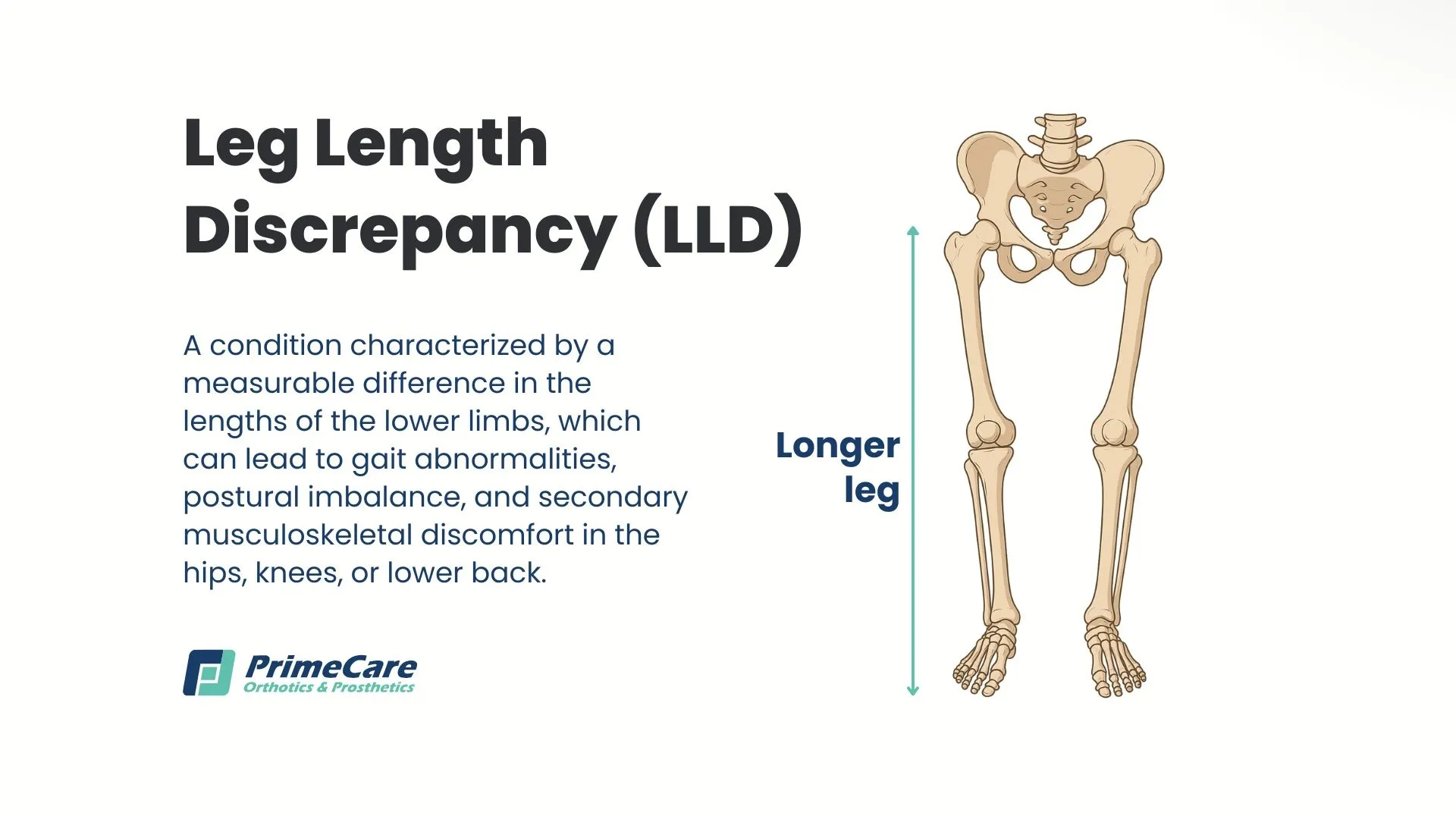 Leg Length Discrepancy (LLD)