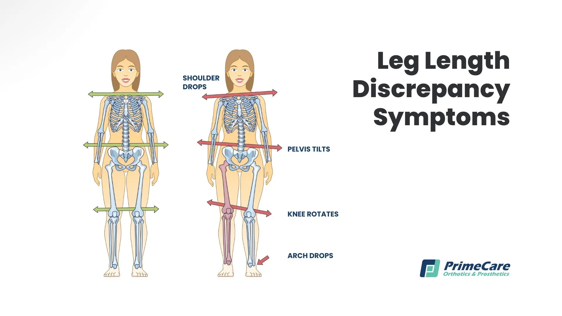 Leg Length Discrepancy Symptoms