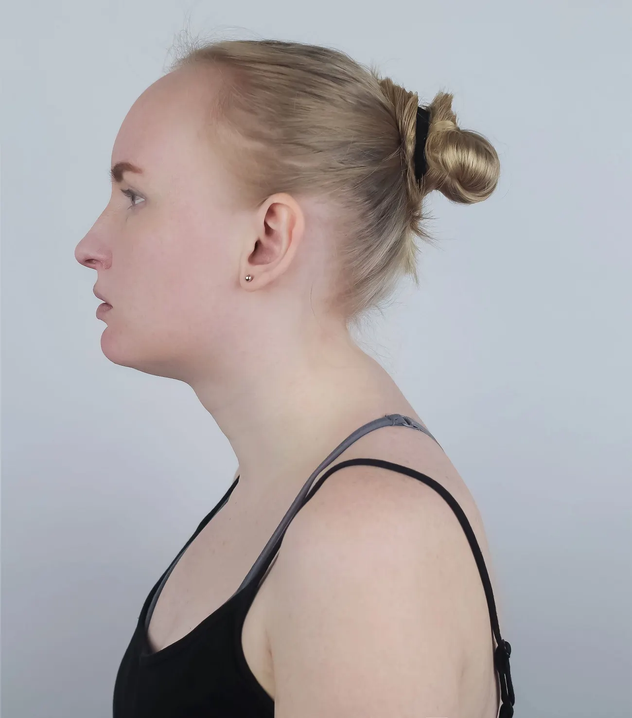 Dealing with Kyphosis