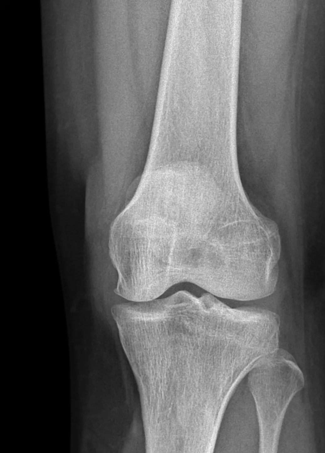 Fibular Hemimelia in Simple Terms: Symptoms, Treatment, and Prosthetics