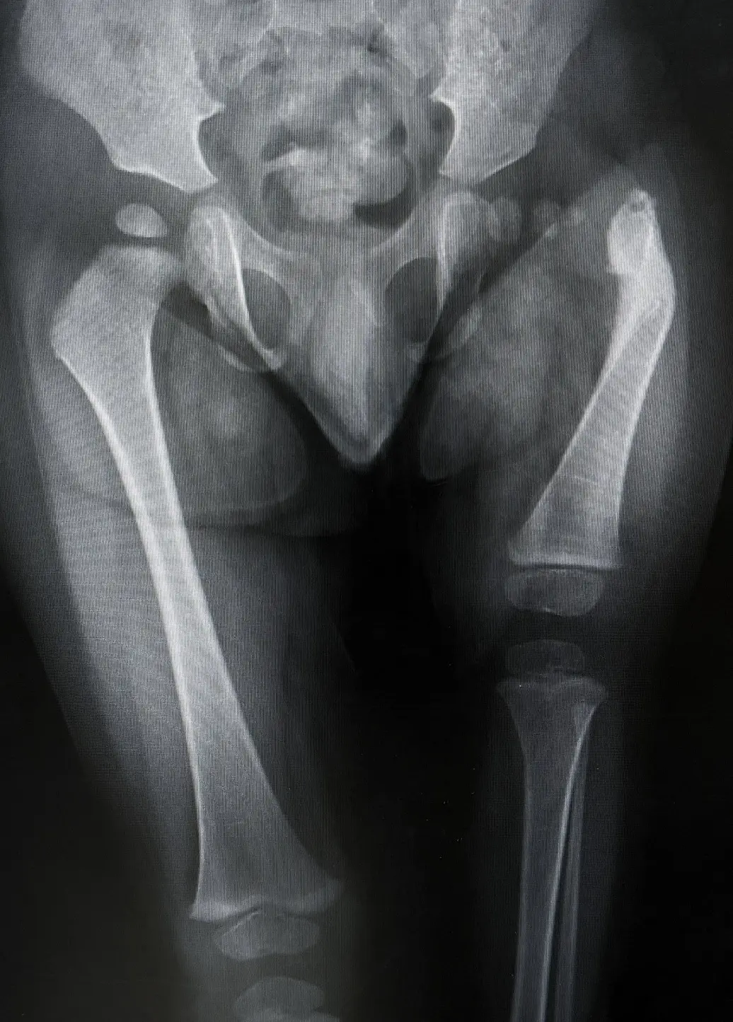 Proximal Femoral Focal Deficiency (PFFD): Advanced Solutions for Mobility