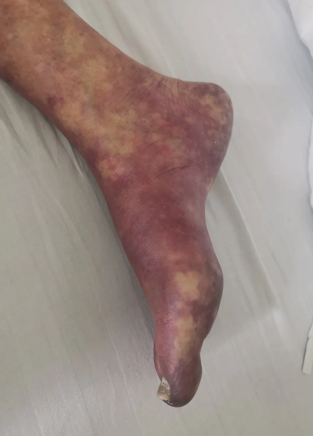 Critical Limb Ischemia: Support for Movement and Function