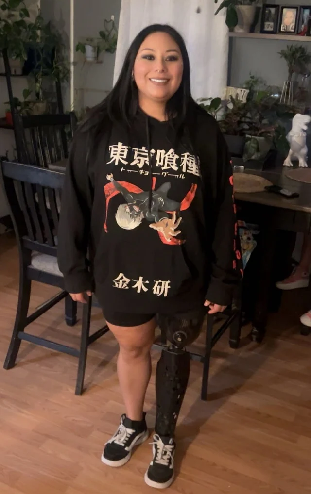 Rebuilding Confidence After Above-Knee Amputation