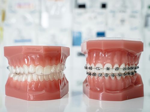Clear Aligners vs. Traditional Braces: Which Option is Right for You ...