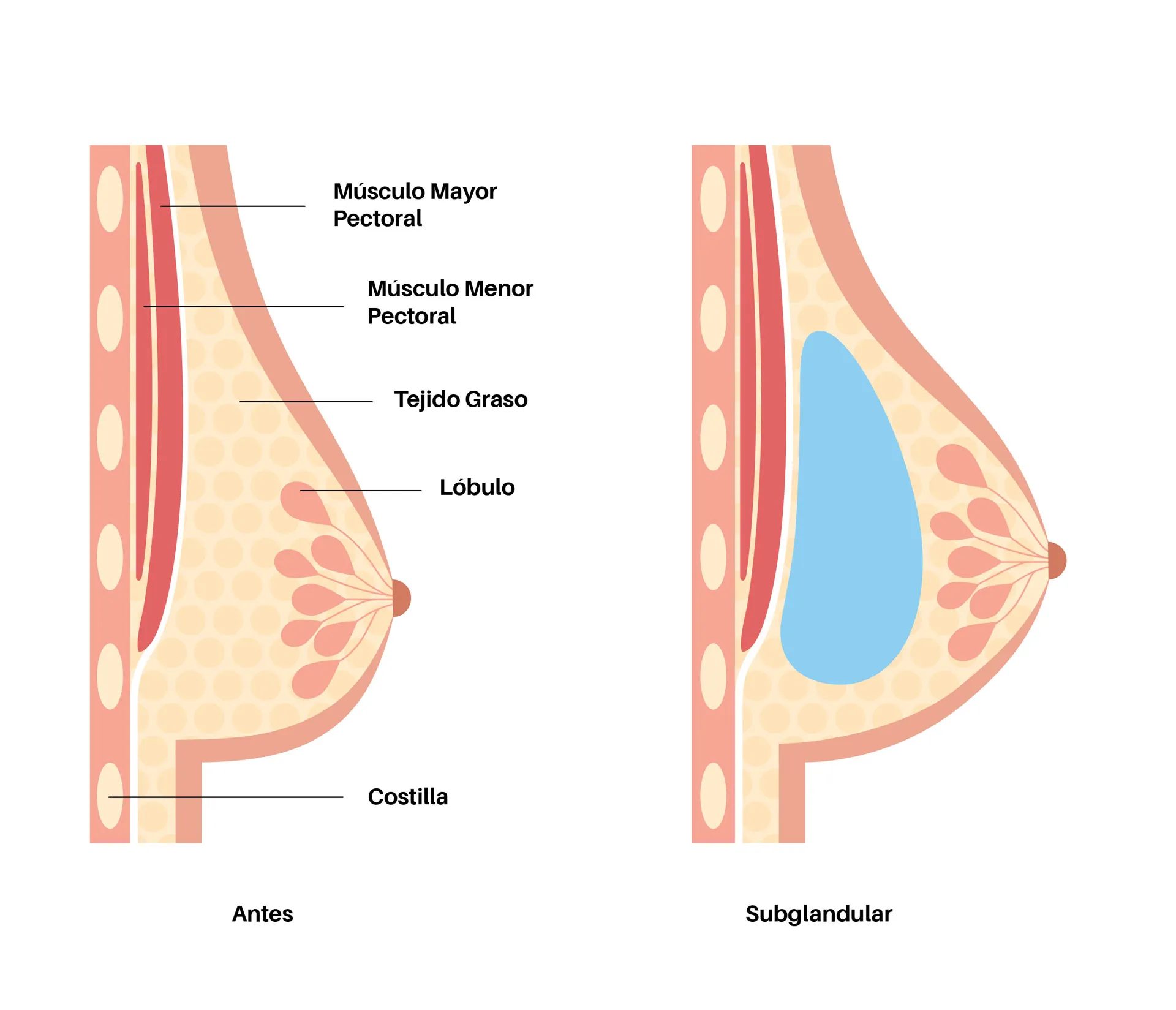 Subglandular placement 