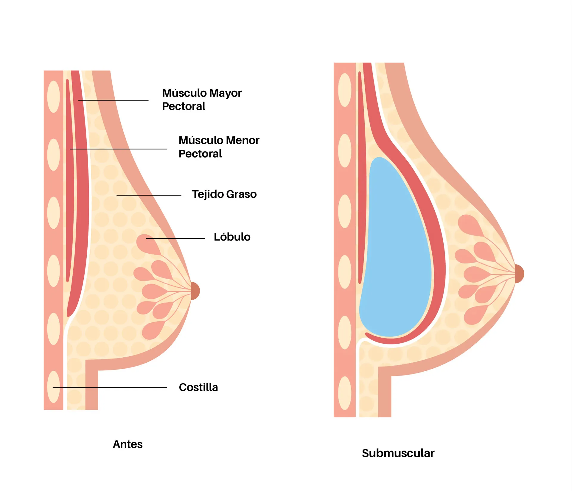 Submuscular placement
