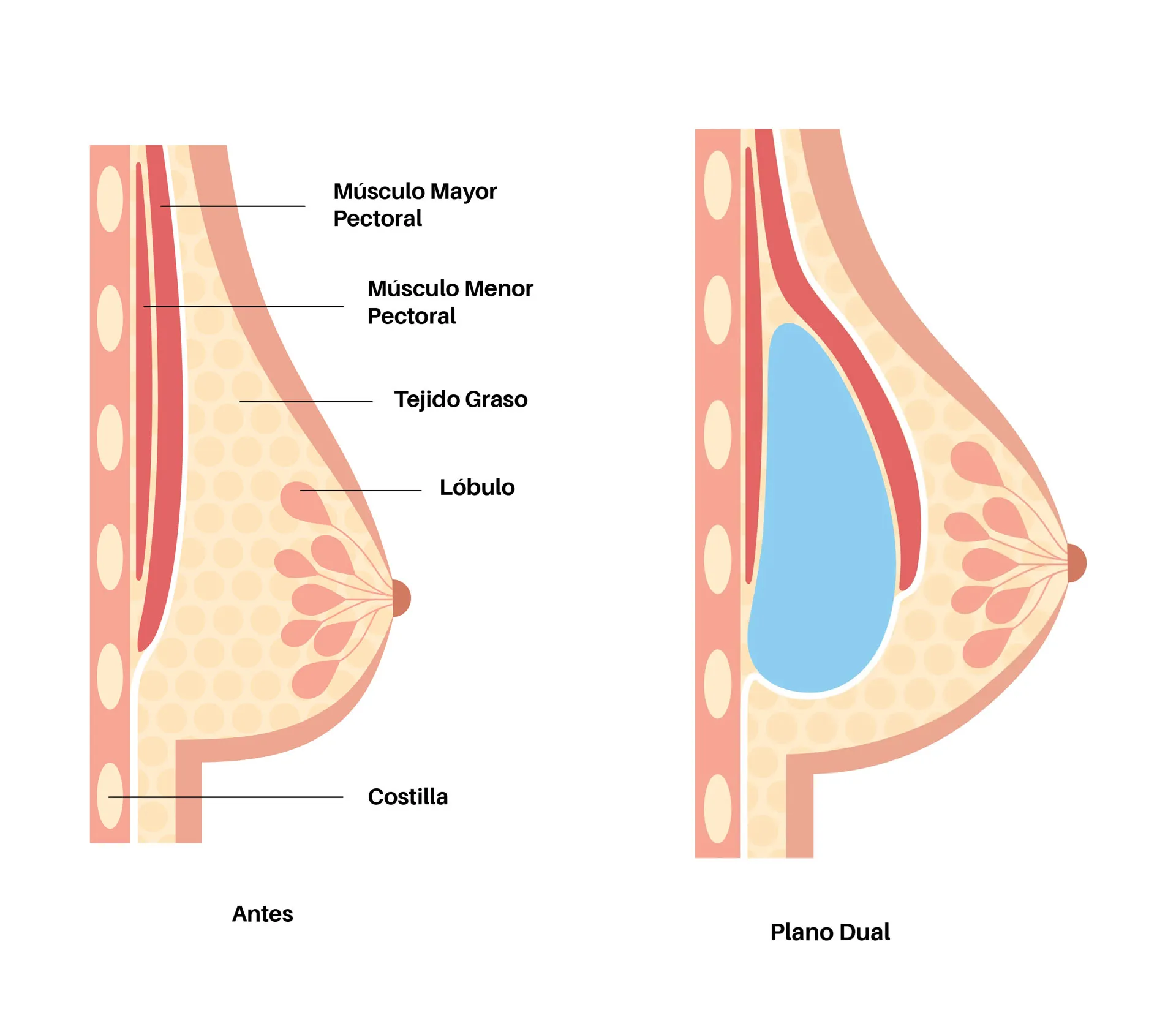 Dual plane placement