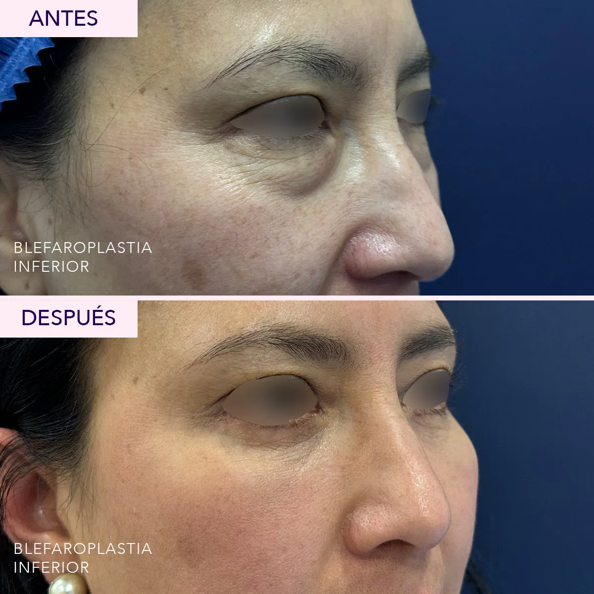 Antes y después blefaroplastia inferior en Bogotá