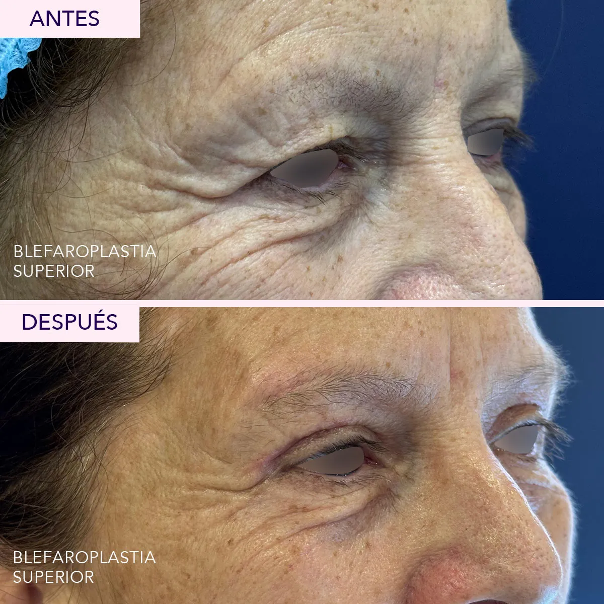 Antes y después blefaroplastia superior en Bogotá
