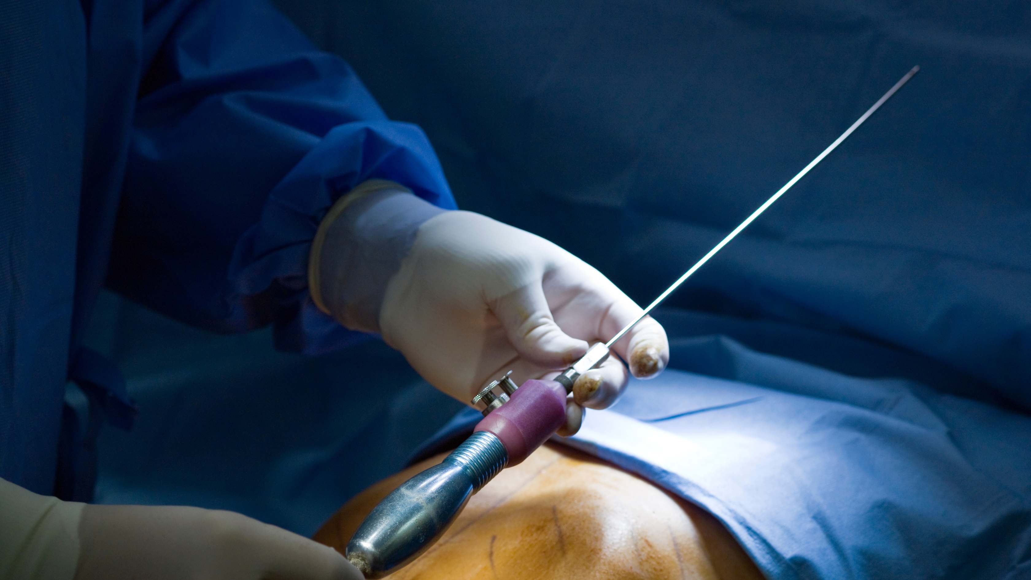 ¿Para qué sirve la faja postoperatoria después de la liposucción o abdominoplastia?