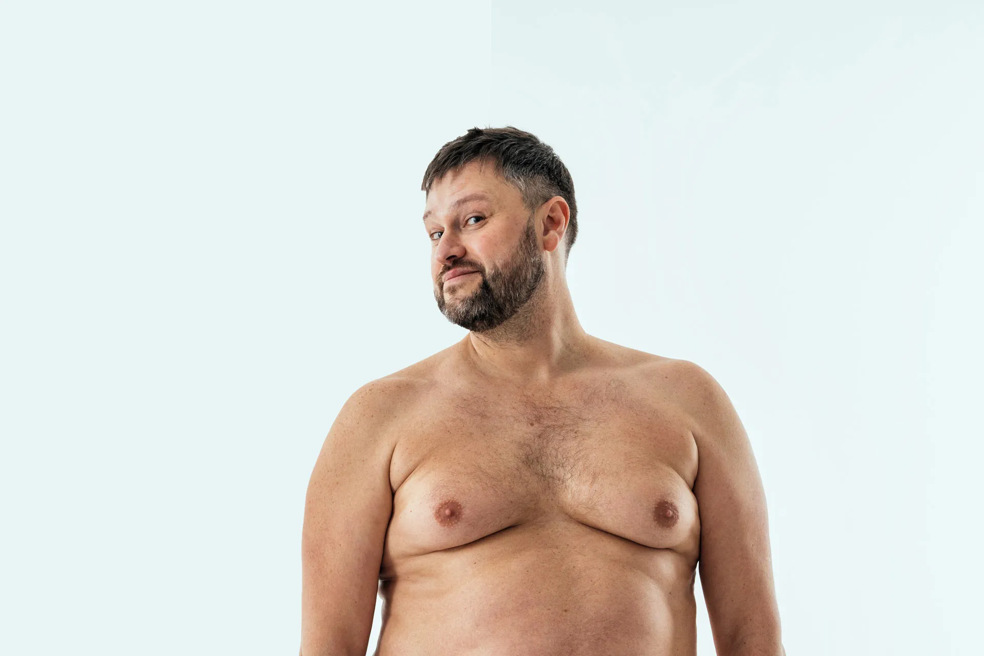 Ginecomastia en Hombres: soluciones quirúrgicas para la reducción de senos masculinos