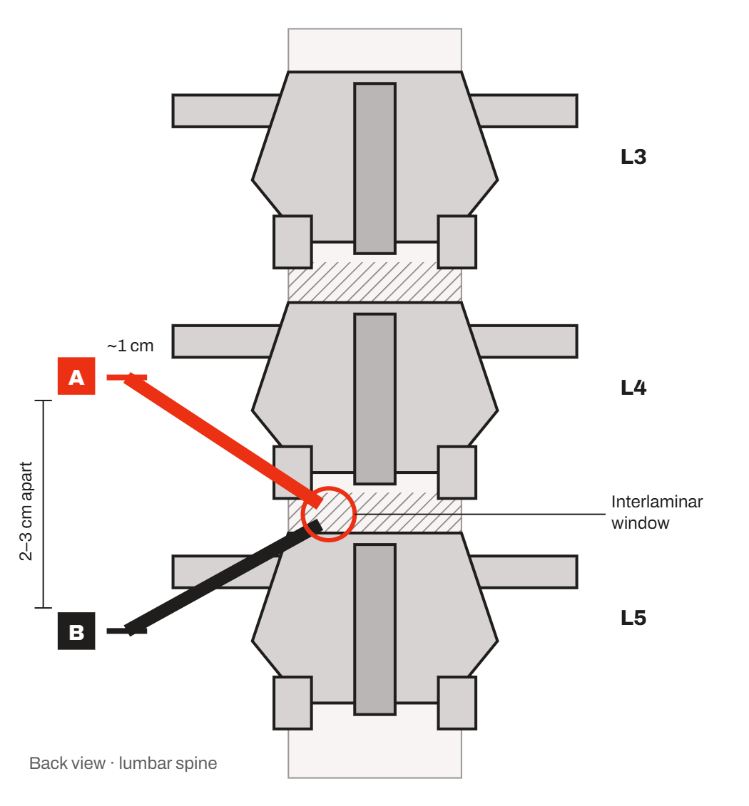Diagram, back view of the lumbar spine: two UBE portals, each about 1 cm and 2 to 3 cm apart, meeting at the interlaminar window between L4 and L5