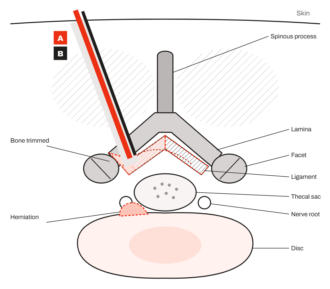 Diagram, cross-section of a lumbar vertebra: the two UBE instruments reach the disc herniation beside the thecal sac and nerve root after a small amount of bone and ligament is trimmed; the facet joints are left alone