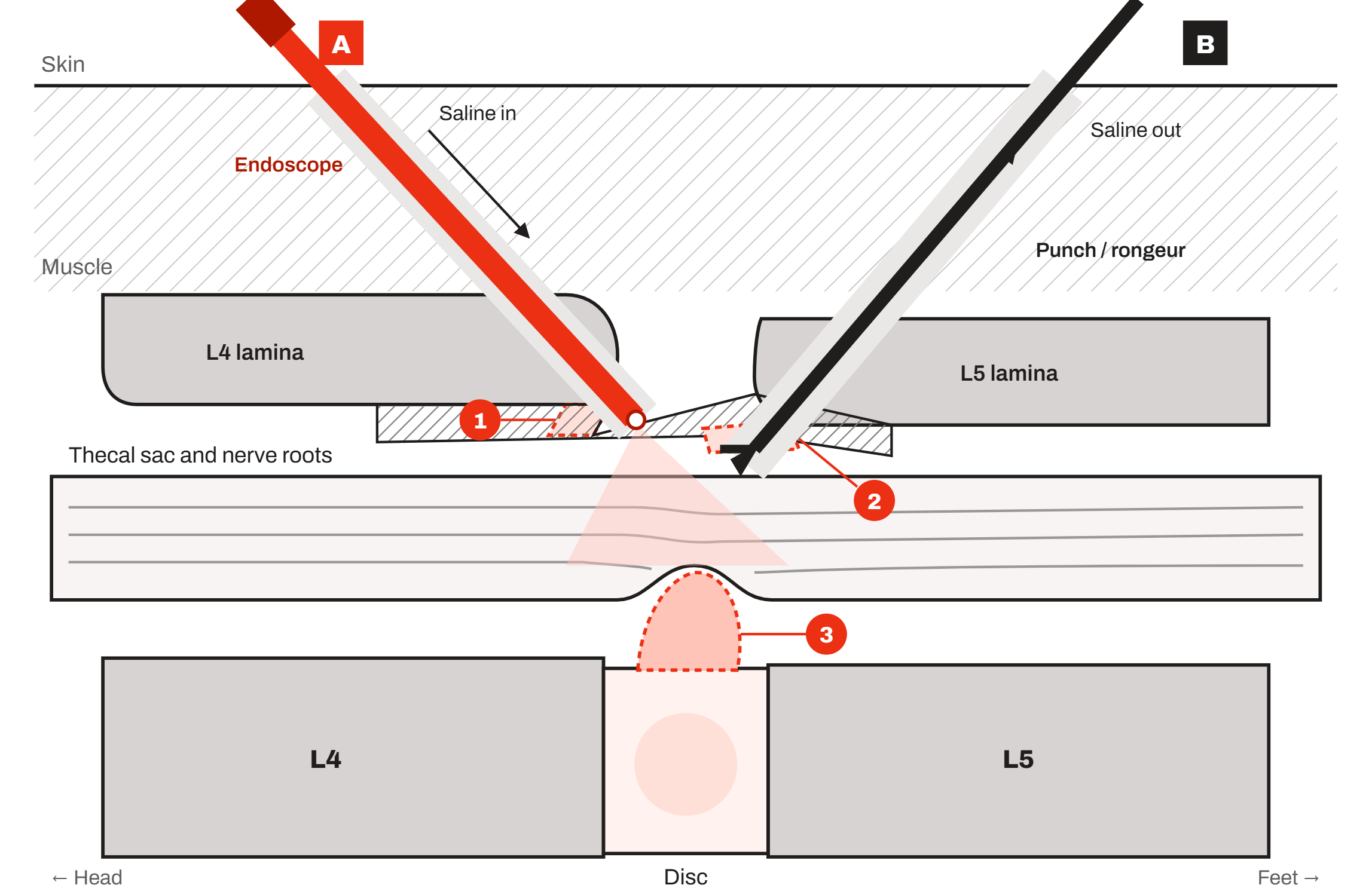 Diagram, side view inside the spinal canal: the endoscope and a working instrument enter between the L4 and L5 laminae, with saline flowing in and out, to reach a disc herniation pressing on the nerve roots