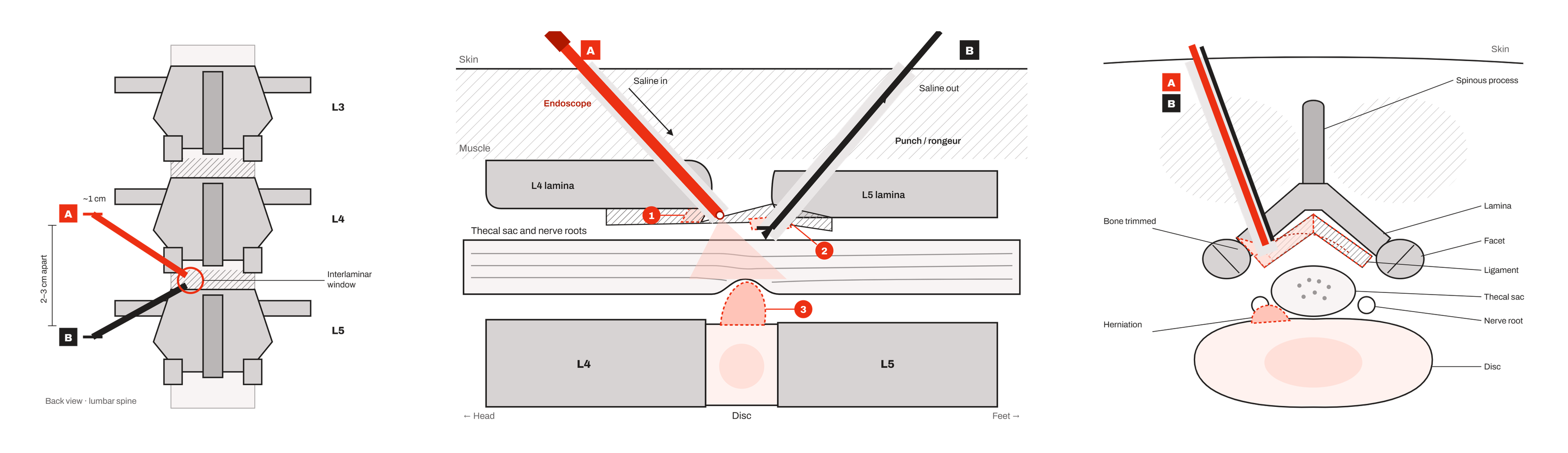 Three diagrams of UBE spine surgery: back view of the two portals at the interlaminar window, side view of the endoscope and instrument inside the canal reaching a disc herniation, and a cross-section showing the small amount of bone trimmed beside the nerve root