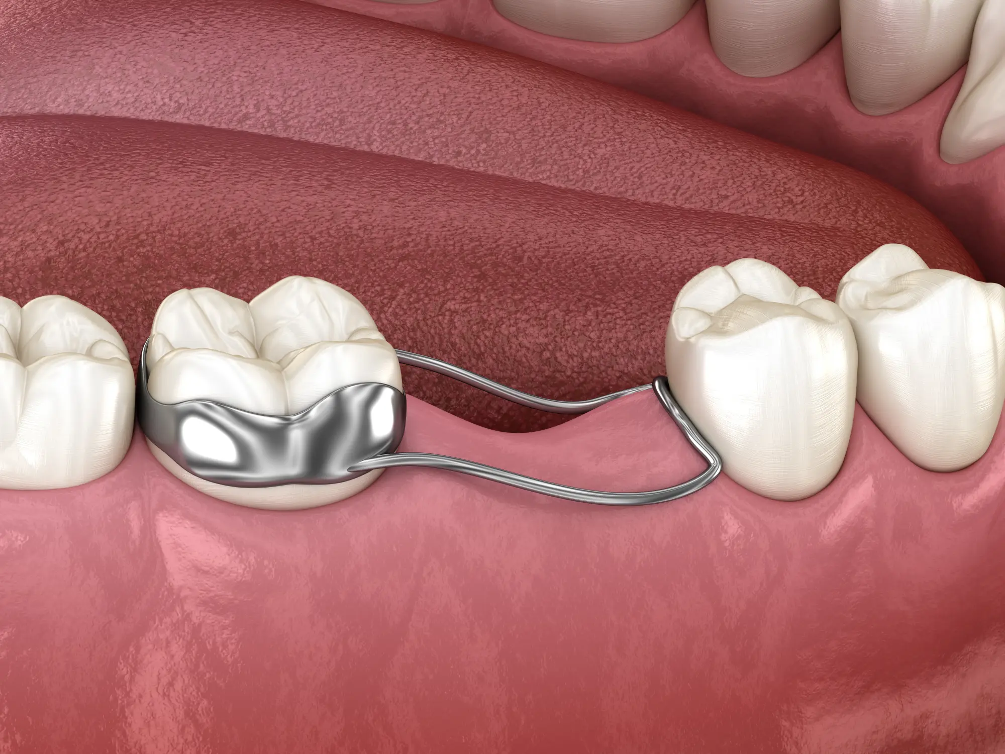 Space maintainers are small, custom-made dental devices designed to hold space open in your child’s mouth when a baby tooth is lost prematurely.