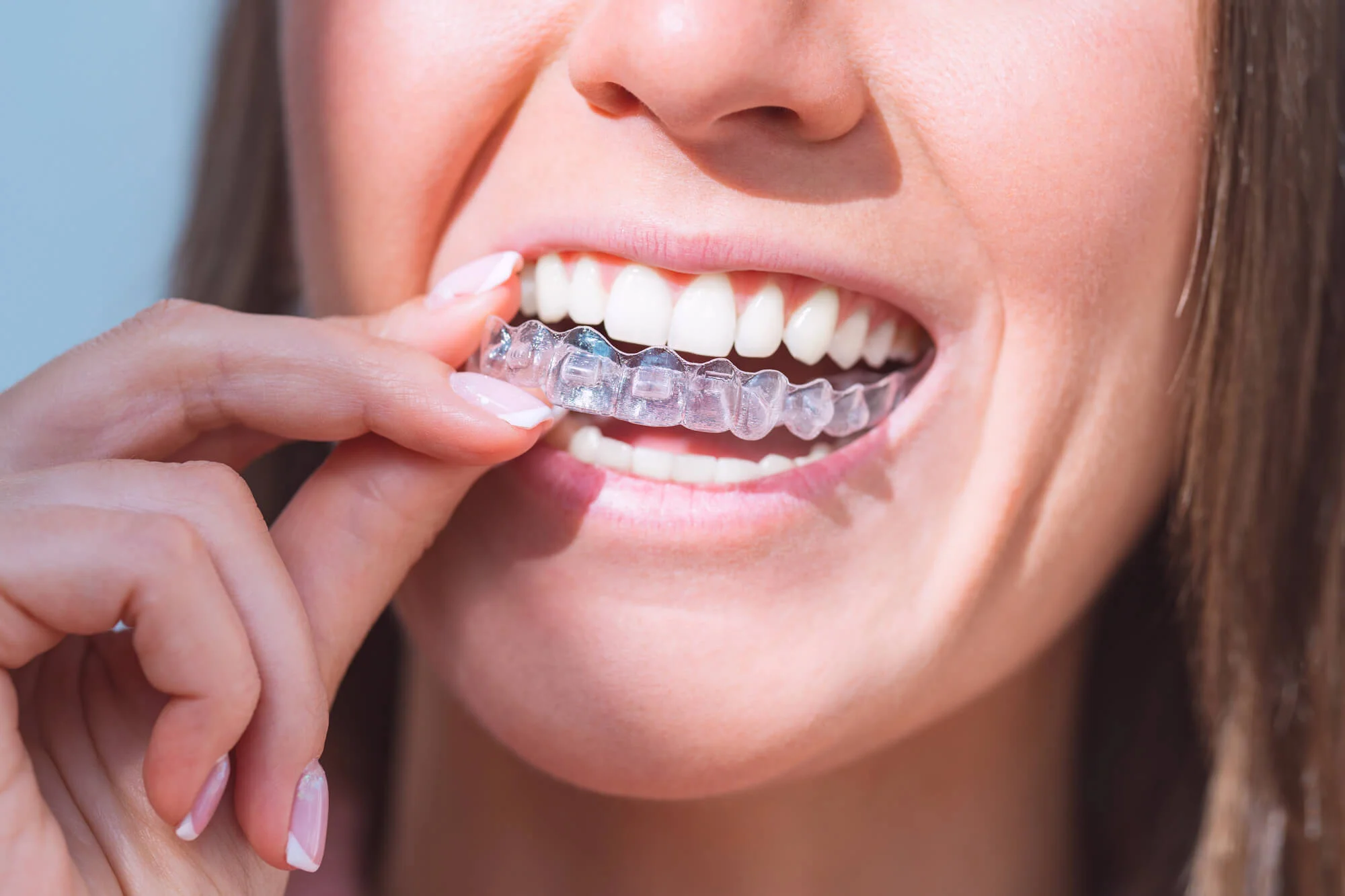 Woman placing clear aligner tray onto teeth, showing a bright smile – Invisalign in San Antonio