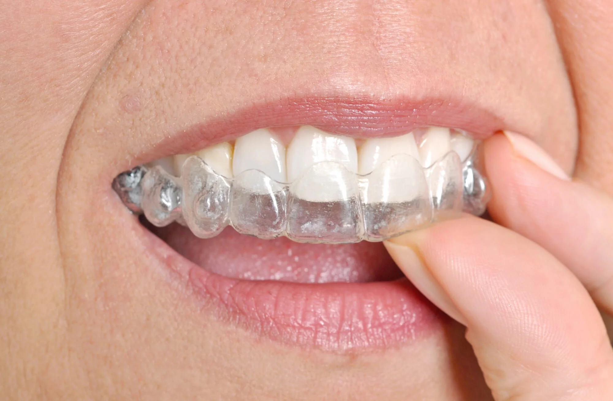 Hand adjusting a clear dental aligner over upper teeth, demonstrating treatment process – Invisalign in San Antonio