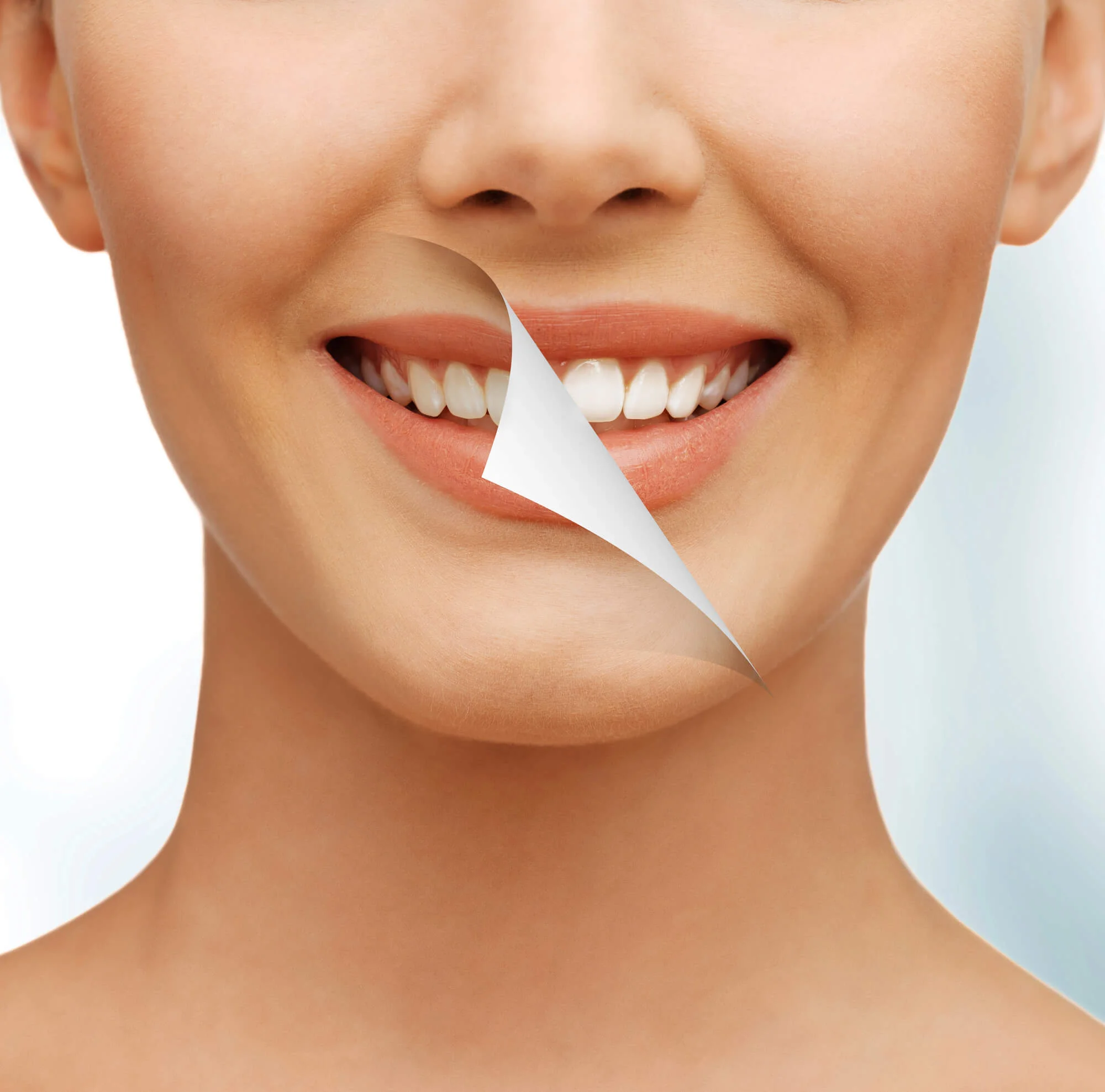 Before and after smile transformation — teeth whitening in San Antonio, TX