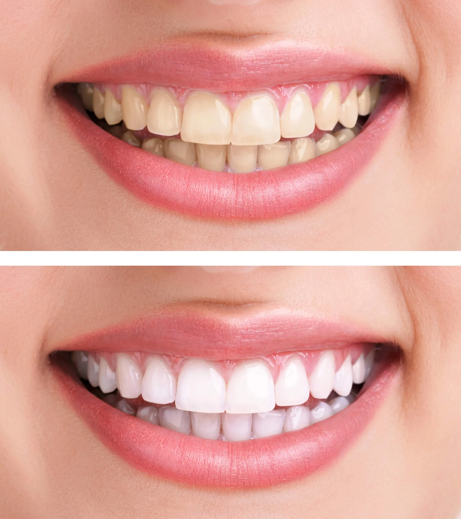 Before and after smile results — teeth whitening in San Antonio