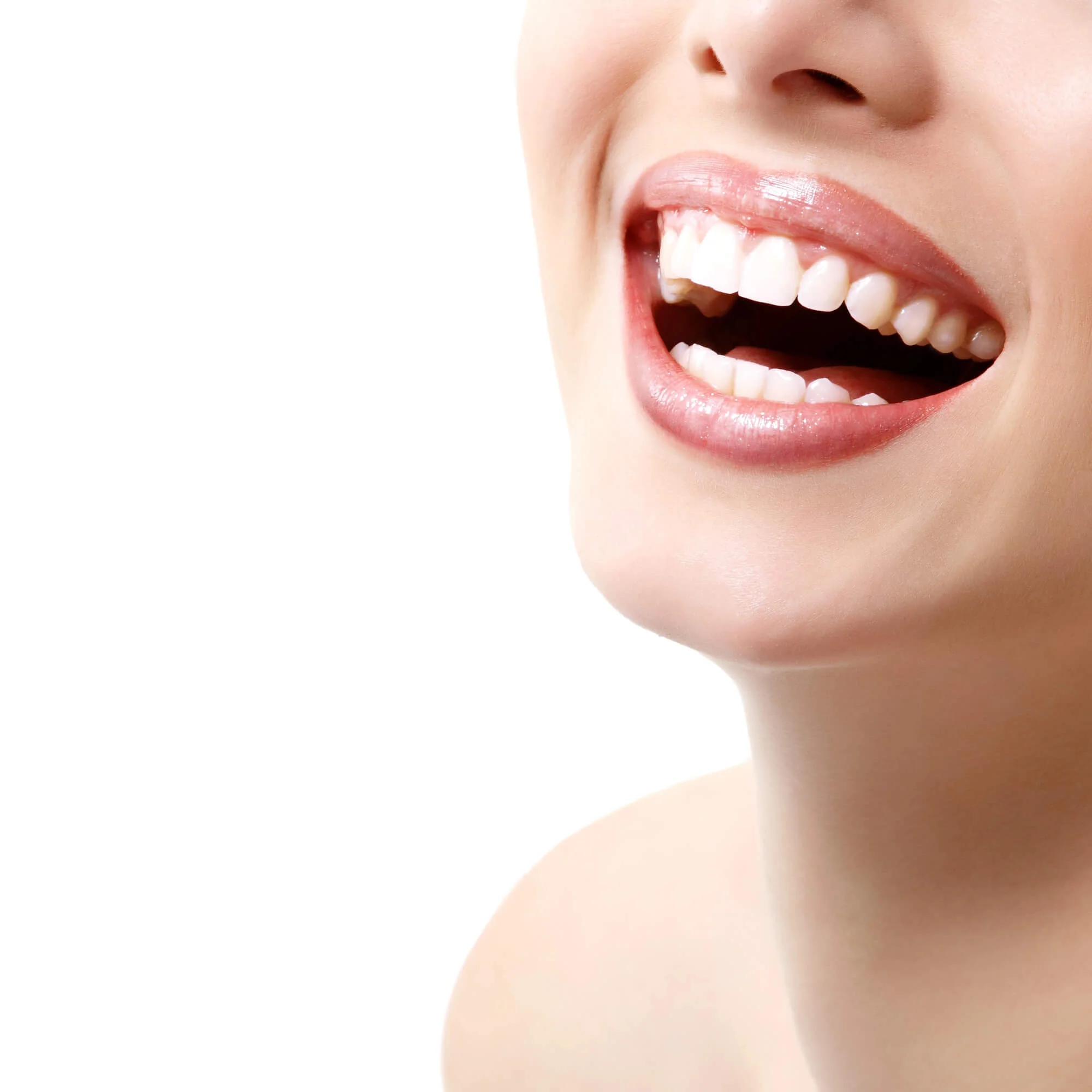 Bright white smile transformation — teeth whitening in San Antonio