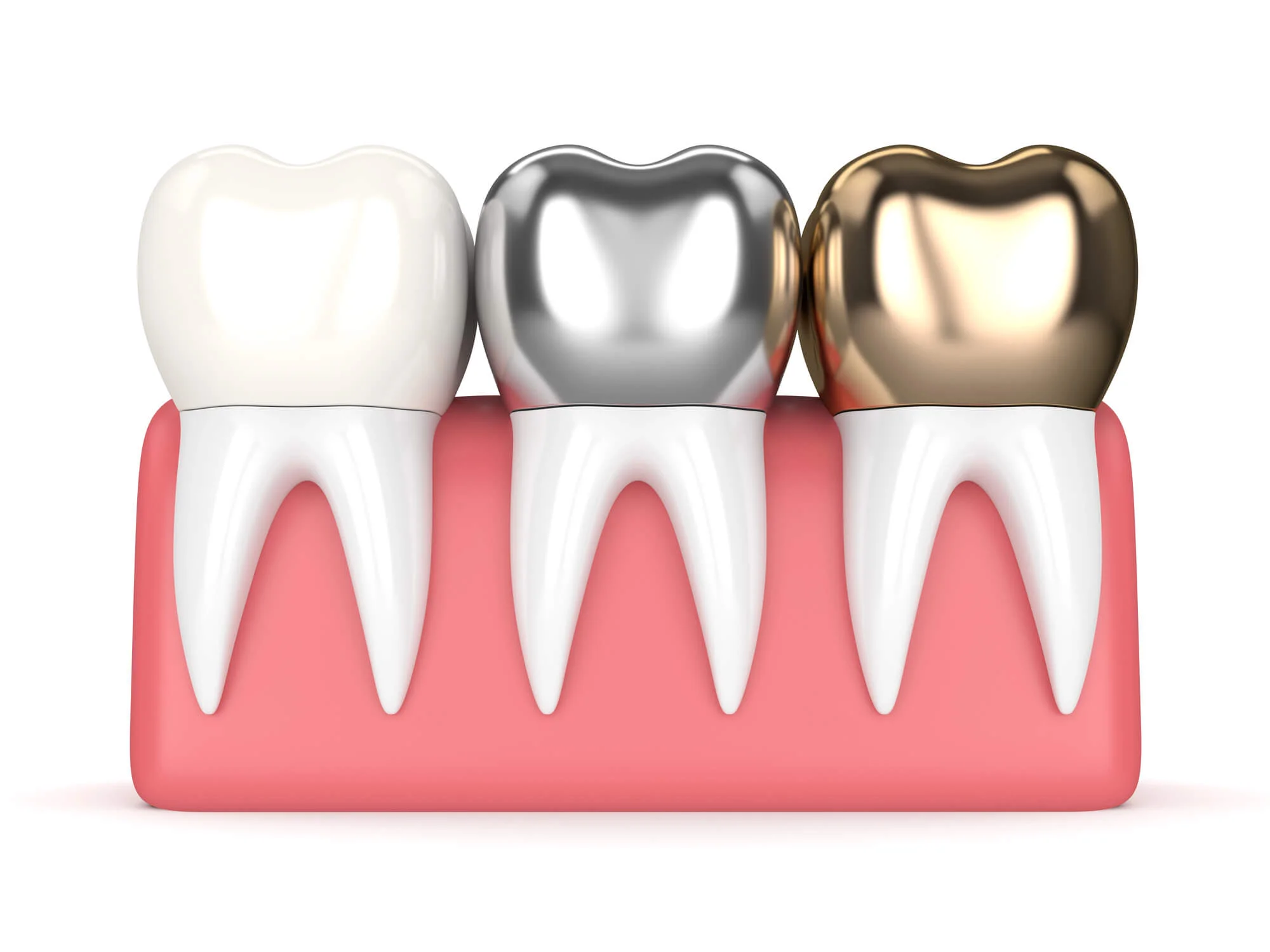 Different options for dental crowns in San Antonio.
