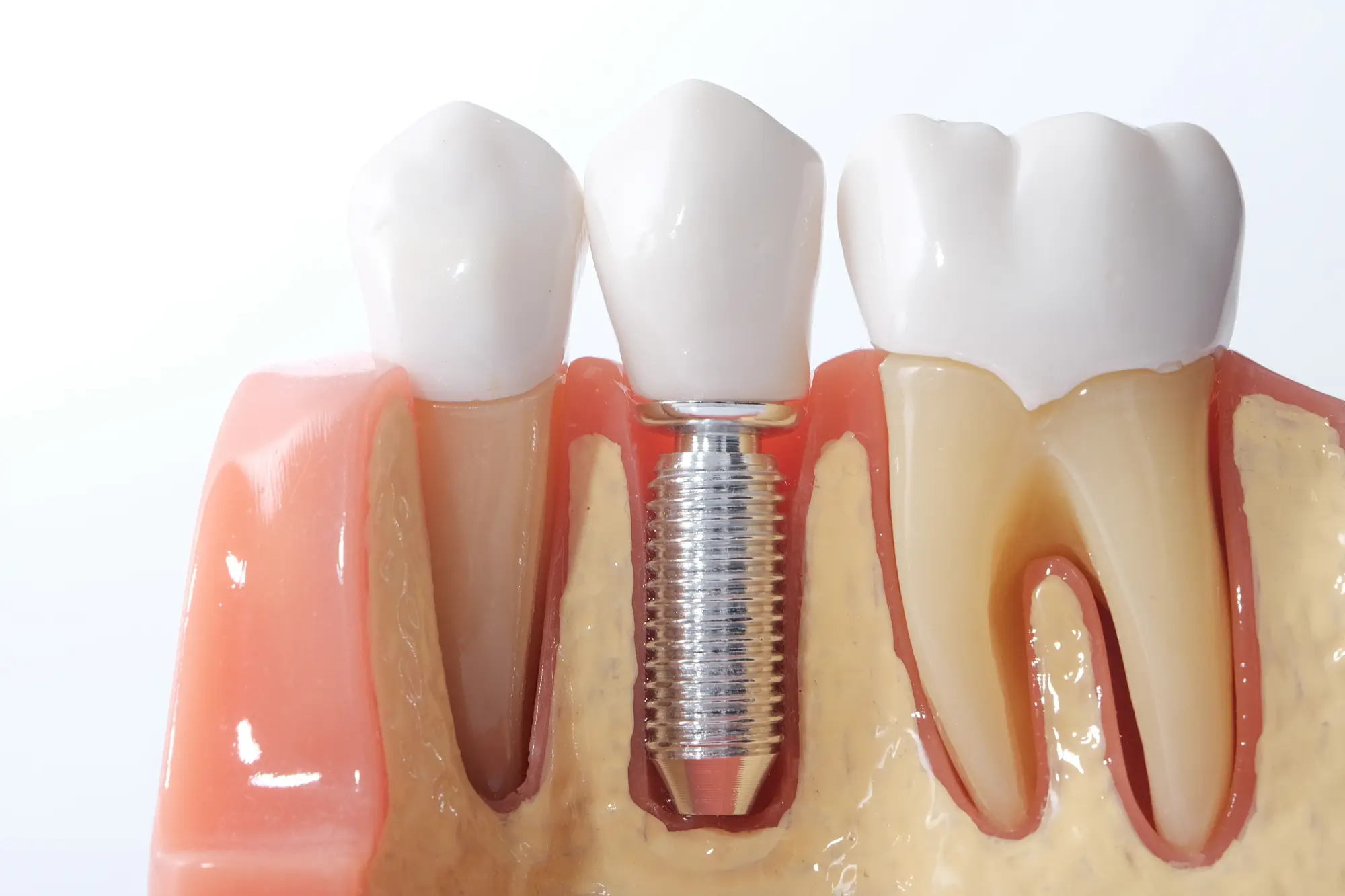 Dental Implants: The Gold Standard for Replacing Missing Teeth in the Upstate