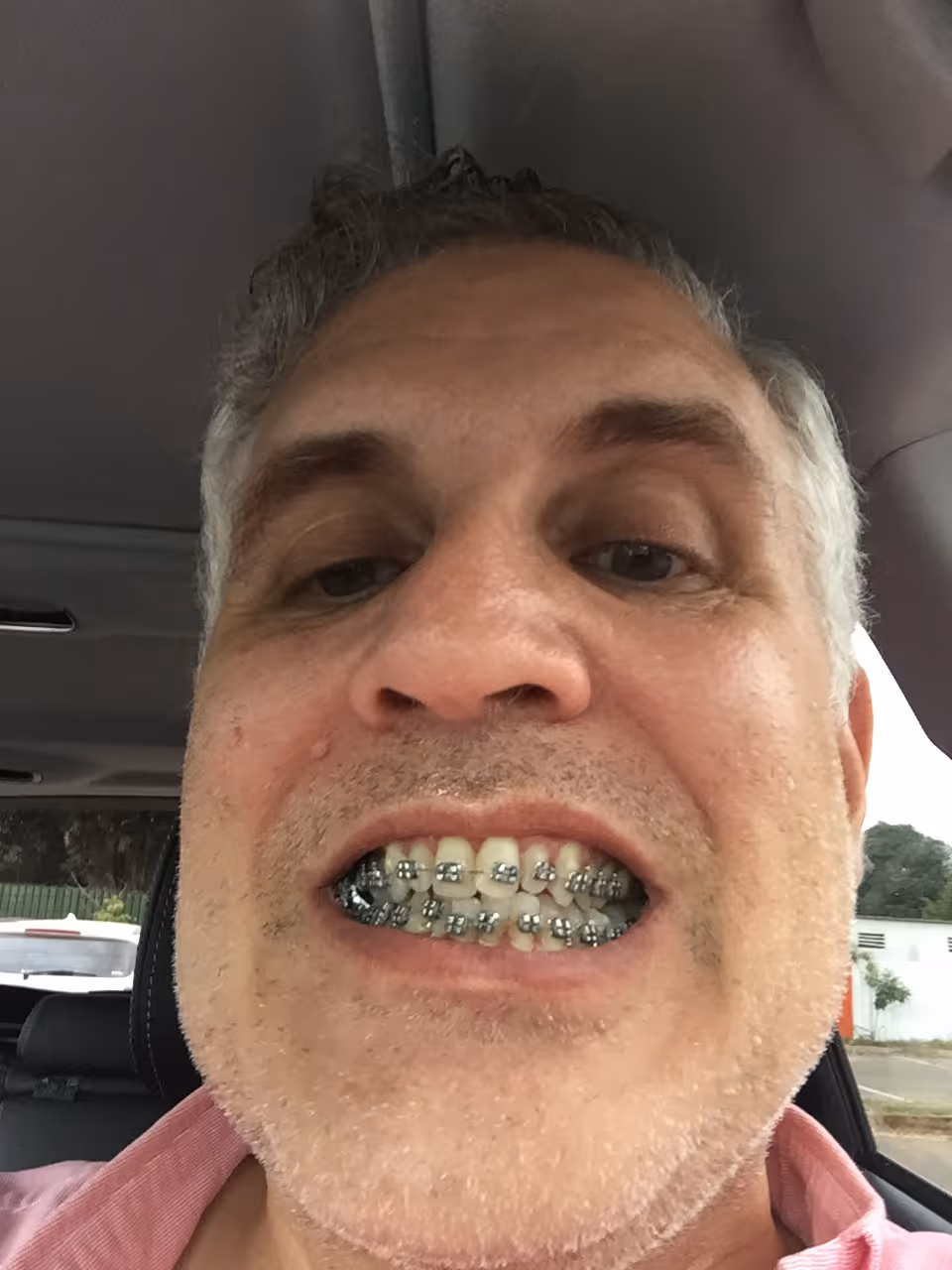 Braces aren't just for teenagers