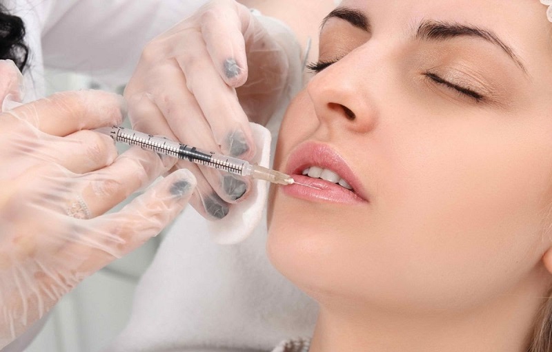 Tiêm filler môi được ưa chuộng bởi cho kết quả nhanh chóng
