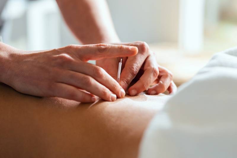 Close-up of acupuncture on a person's back.
