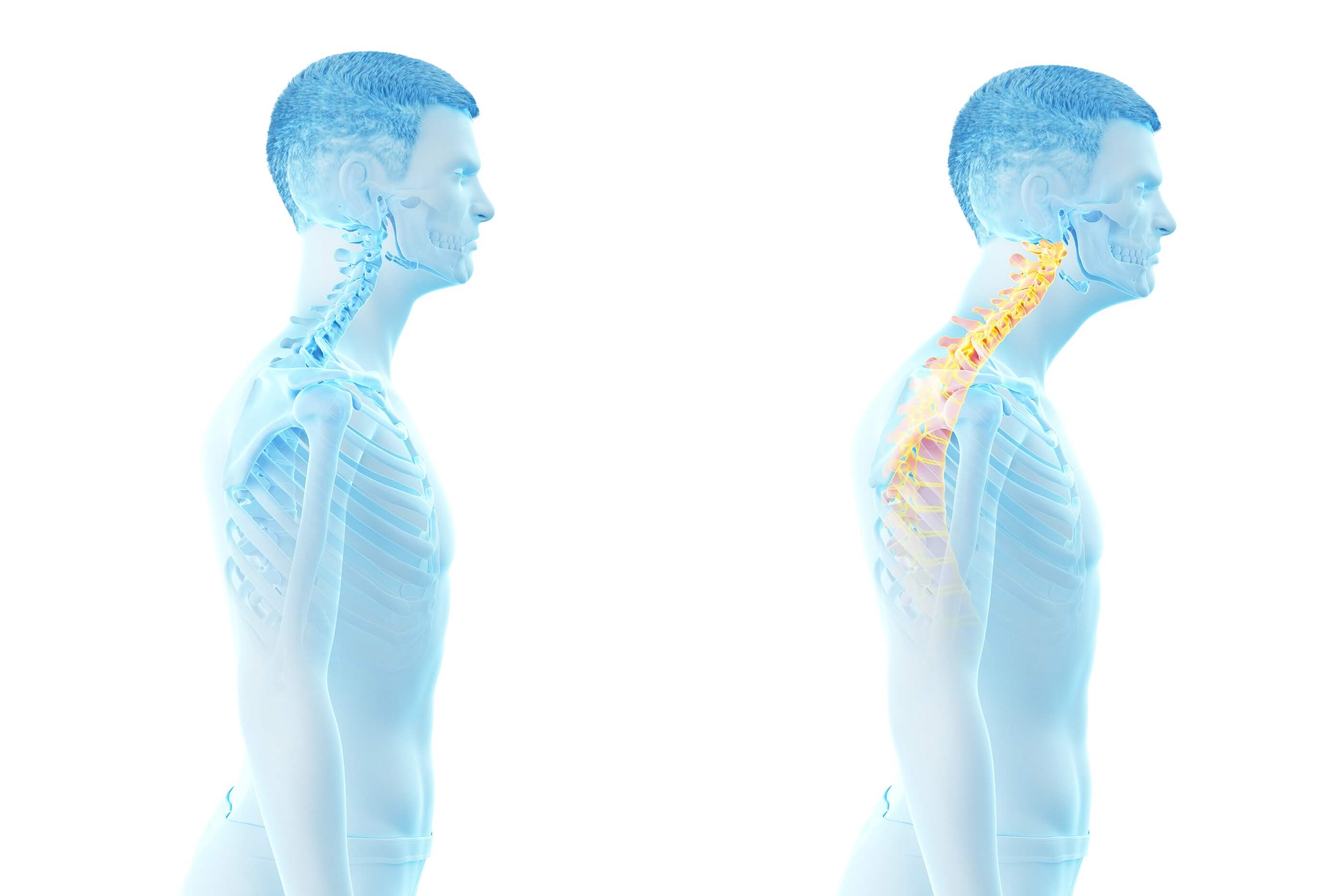 Side-by-side illustration of human spine, showing healthy vs. inflamed spinal region.