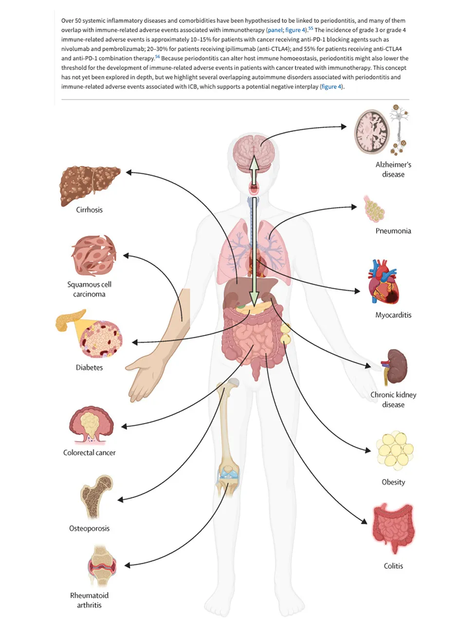 Human body diagram showing diseases linked to periodontitis including Alzheimer's, pneumonia, myocarditis, chronic kidney disease, obesity, colitis, rheumatoid arthritis, osteoporosis, colorectal cancer, diabetes, squamous cell carcinoma, and cirrhosis, with arrows pointing to corresponding organs.