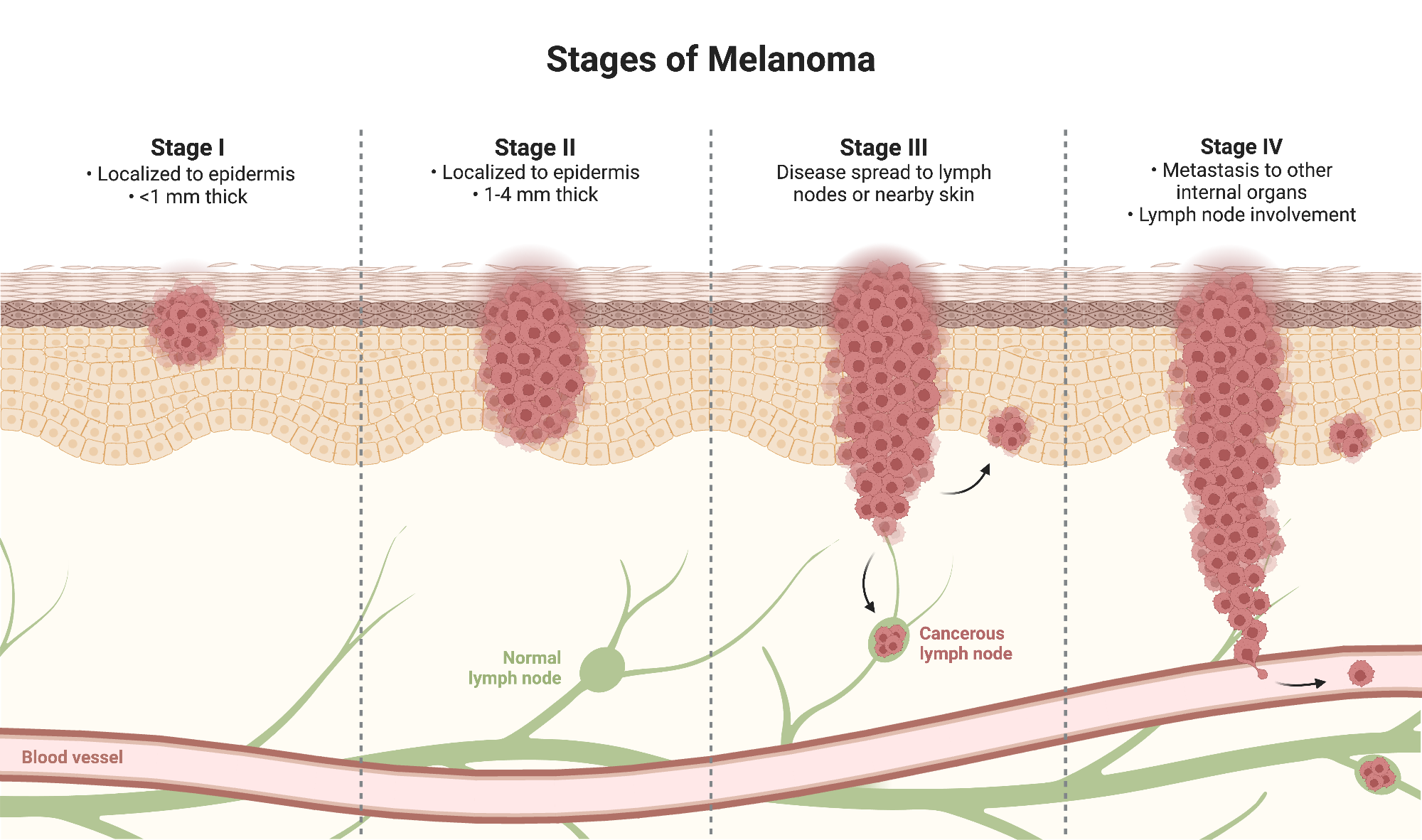 Stage 4 Melanoma Staging Melanoma Stages Chart LCKM