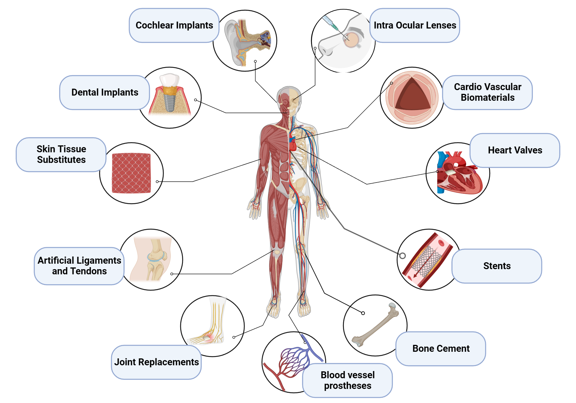 An editable high resolution scientific image depicting Biomedical applications of Implants