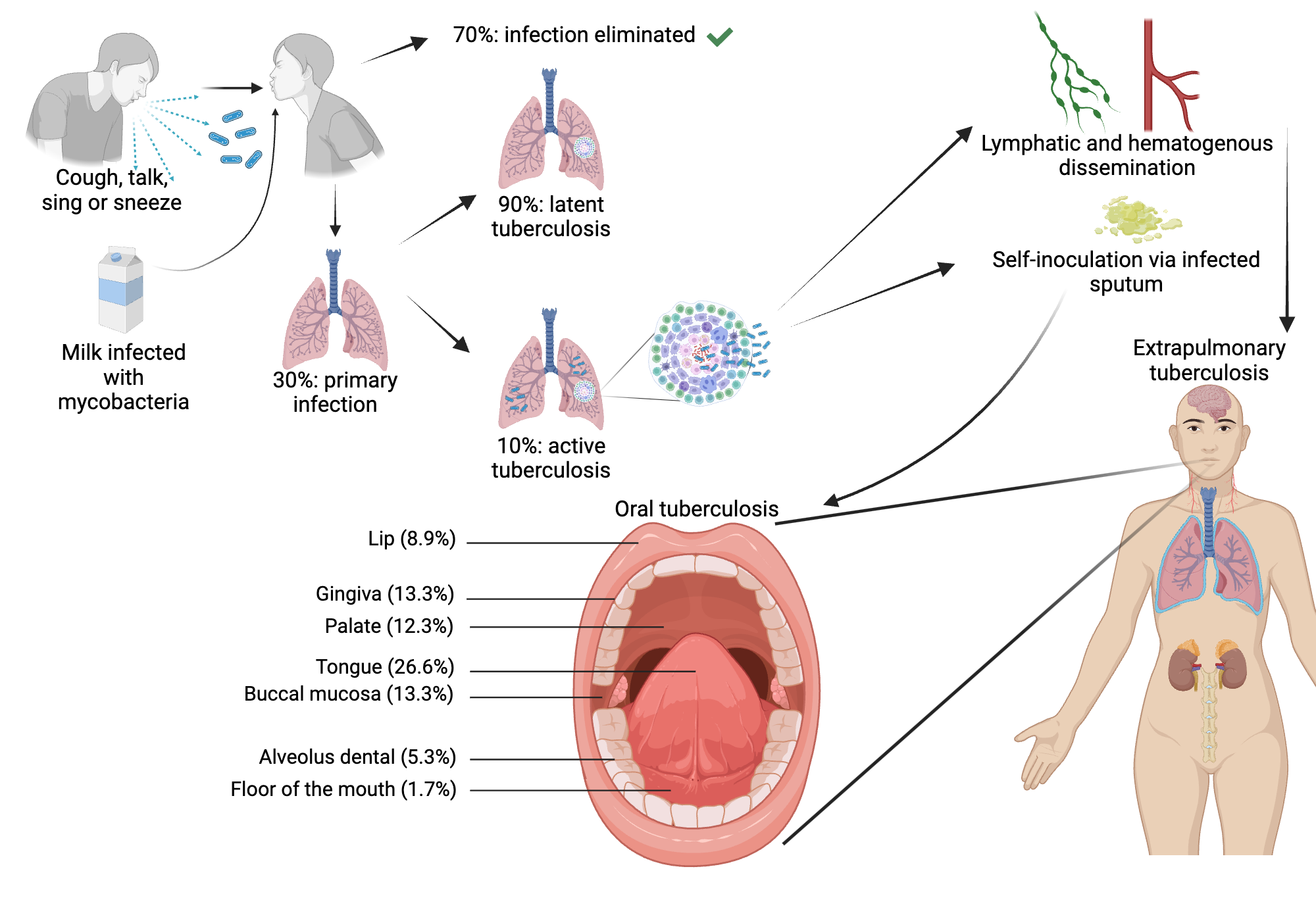 An editable high resolution scientific image depicting Oral Tuberculosis