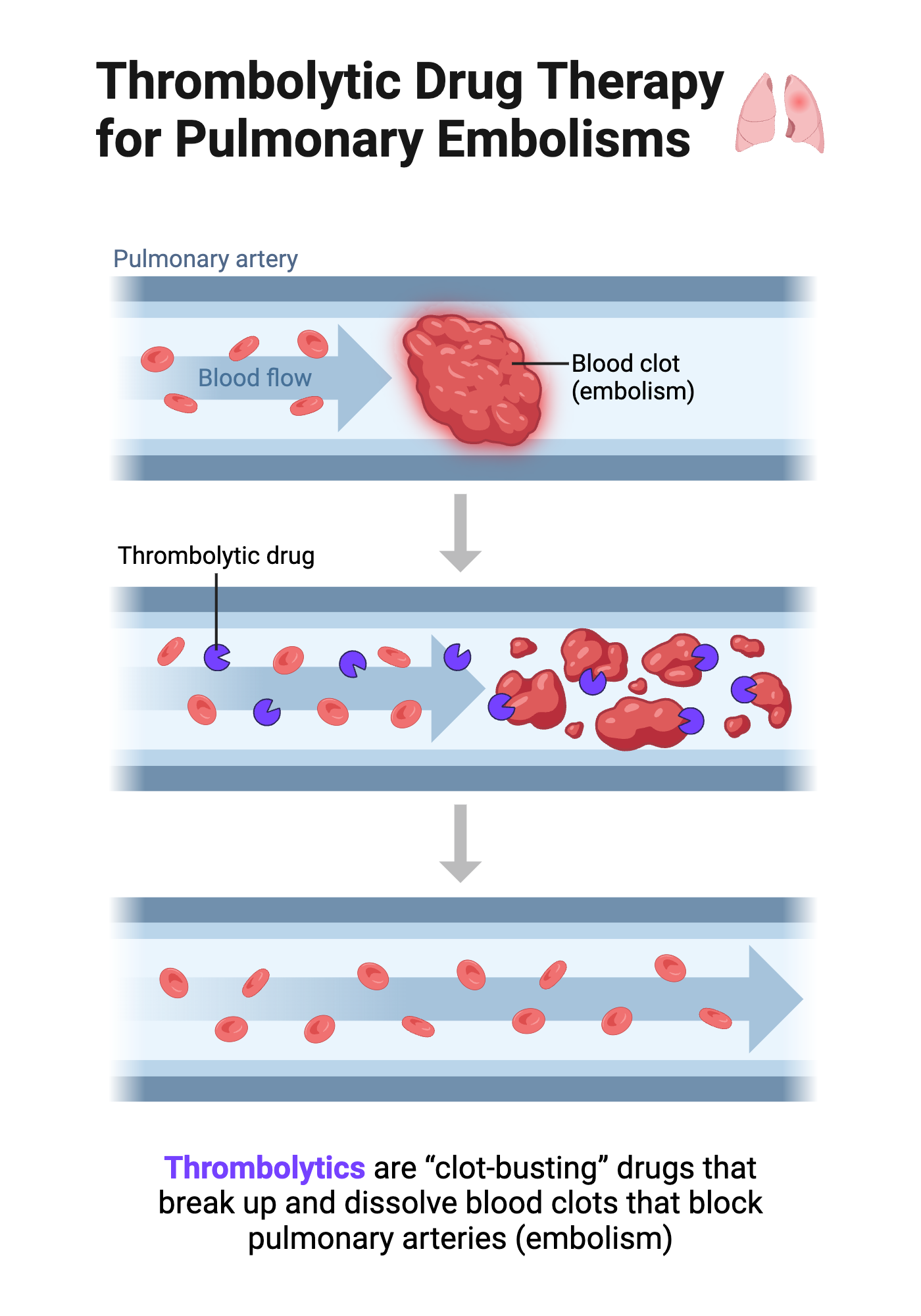 Thrombolytic Drug Therapy For Pulmonary Embolisms BioRender Science thrombolytic-drug-therapy-for-pulmonary-embolisms-biorender-science