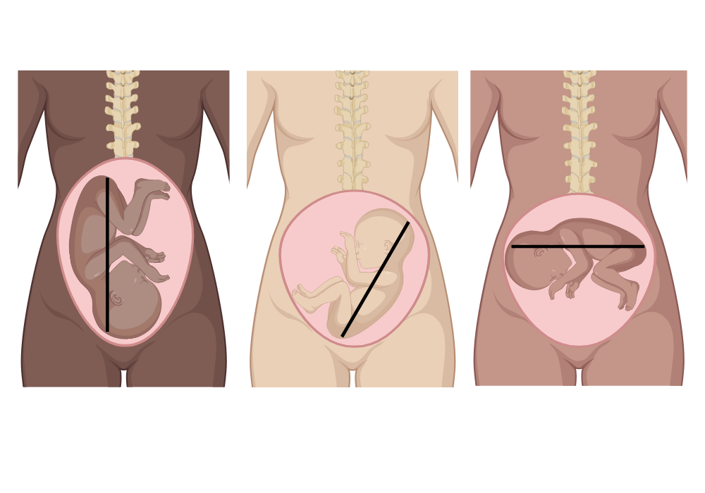 An editable high resolution scientific image depicting Fetal lies