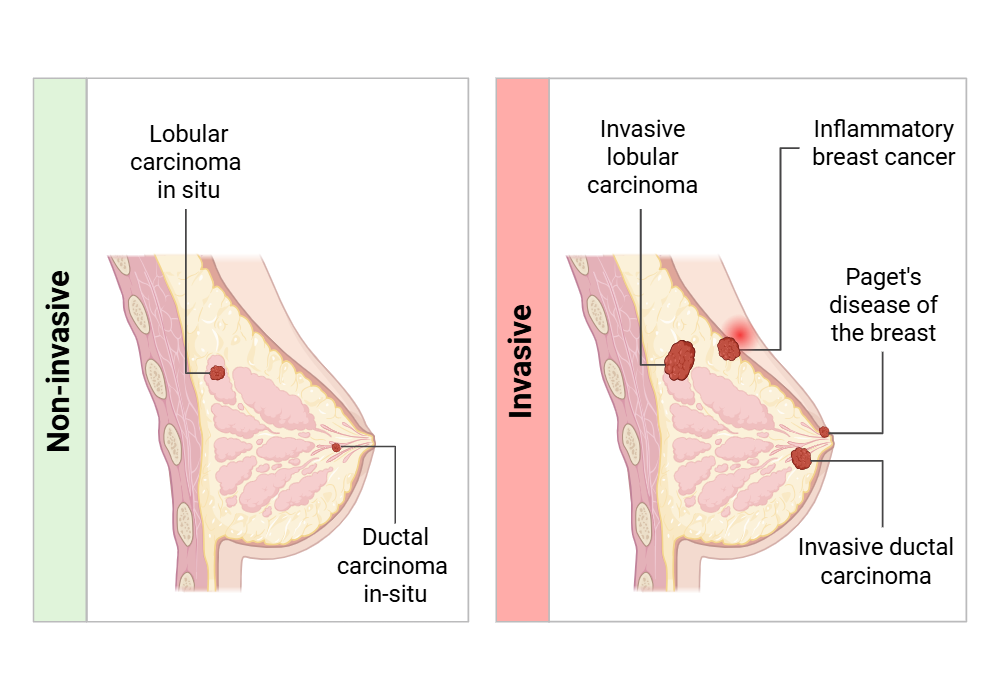 An editable high resolution scientific image depicting Classification of Breast Cancer: Non-Invasive vs Invasive