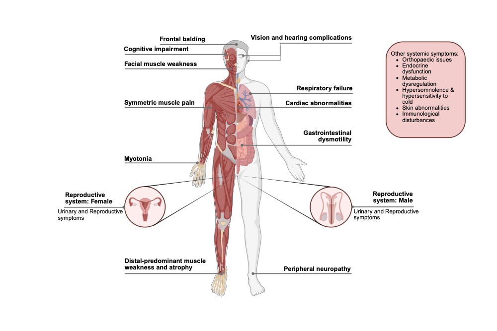 An editable high resolution scientific image depicting Broad spectrum symptoms of Myotonic dystrophy type 1 (DM1).