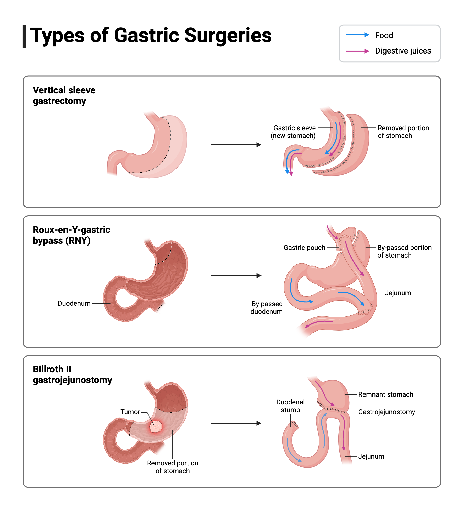 An editable high resolution scientific image depicting Types of Gastric Surgery