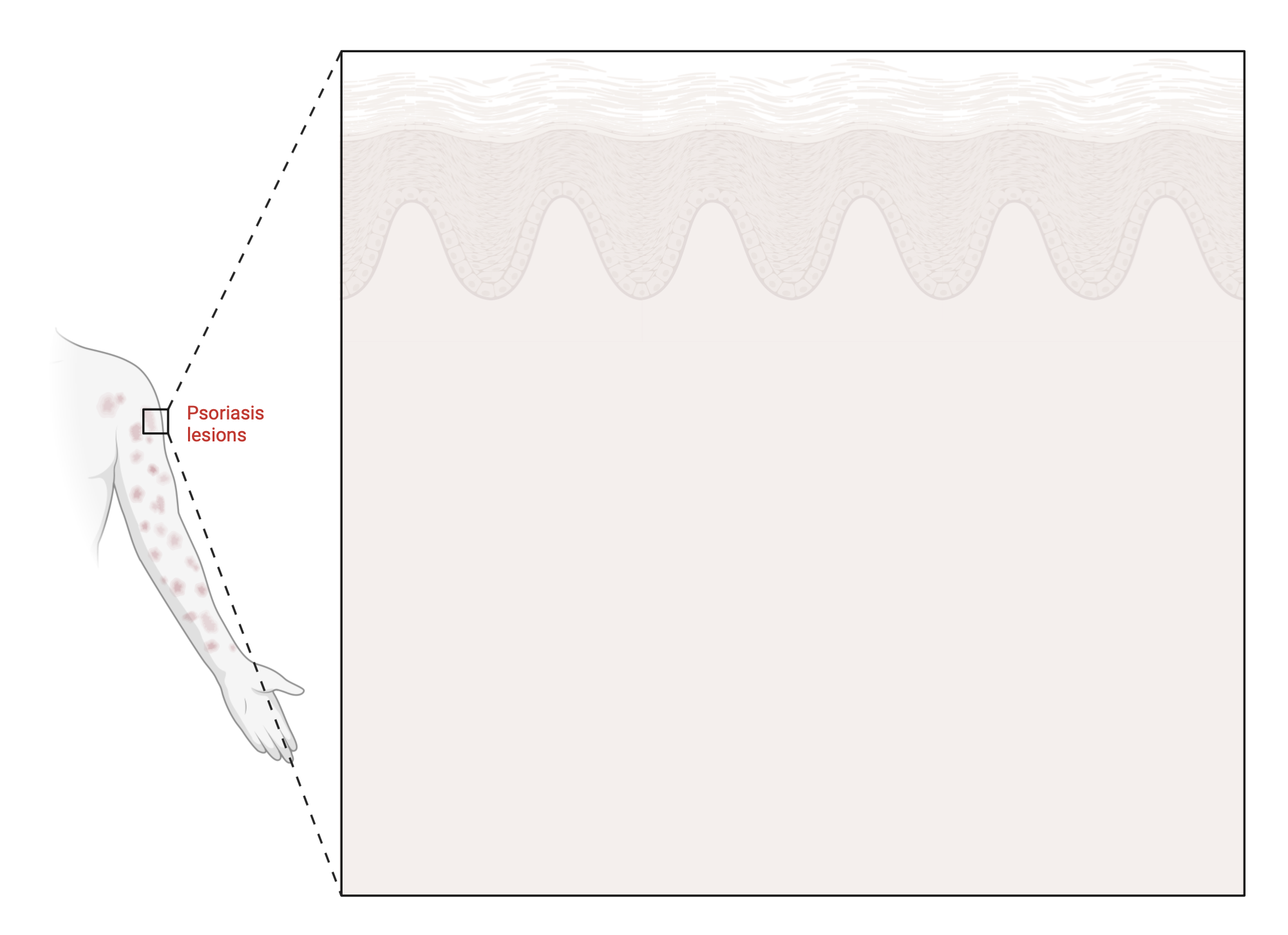 An editable high resolution scientific image depicting Psoriasis Lesions Callout (Layout)