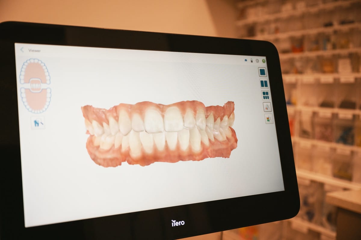 Digital display of a dental model showing upper and lower teeth alignment on a computer screen.