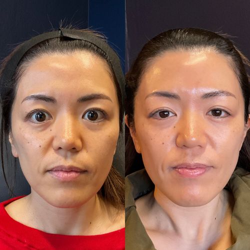Skin Tightening