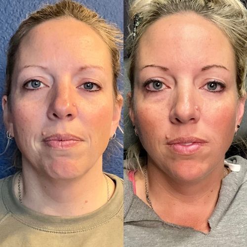 Full Facial Balancing