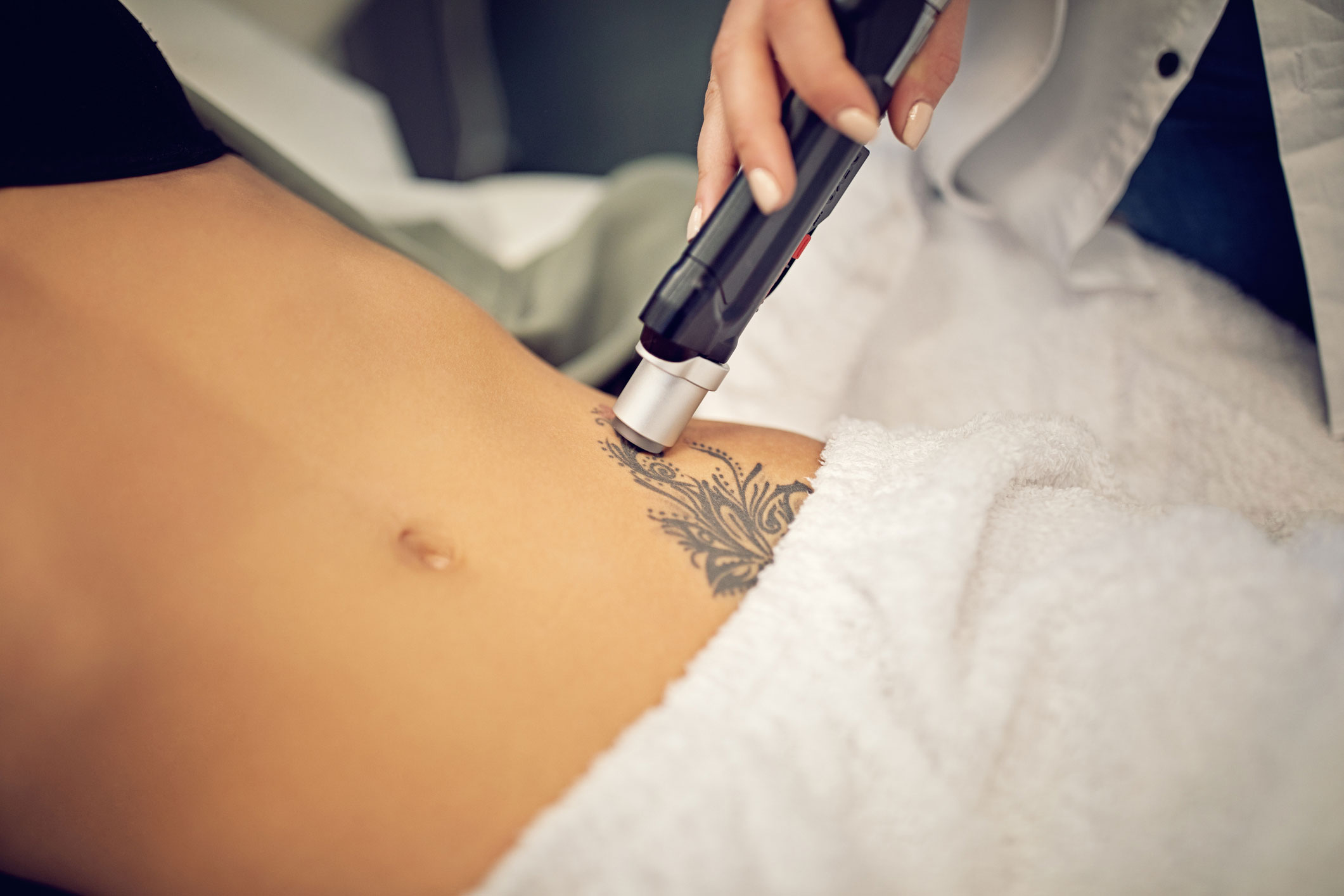 laser-tattoo-removal-factors-affecting-tattoo-removal-edmonton
