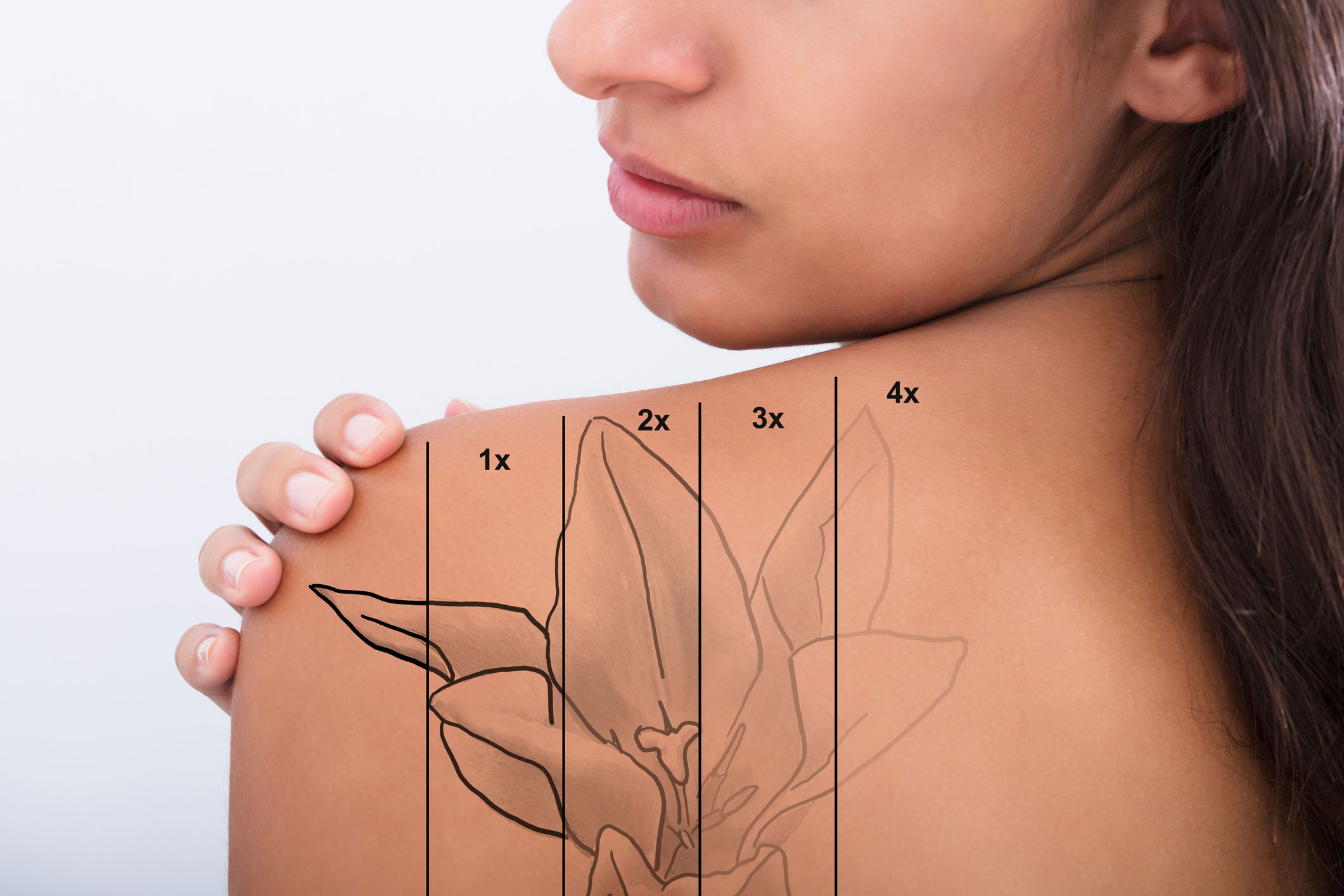 Laser tattoo pre post treatment care edmonton