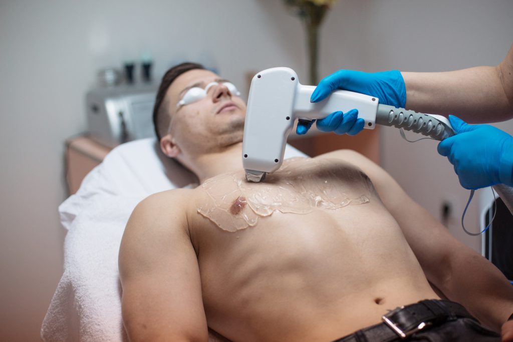 laser-hair-removal-calgary