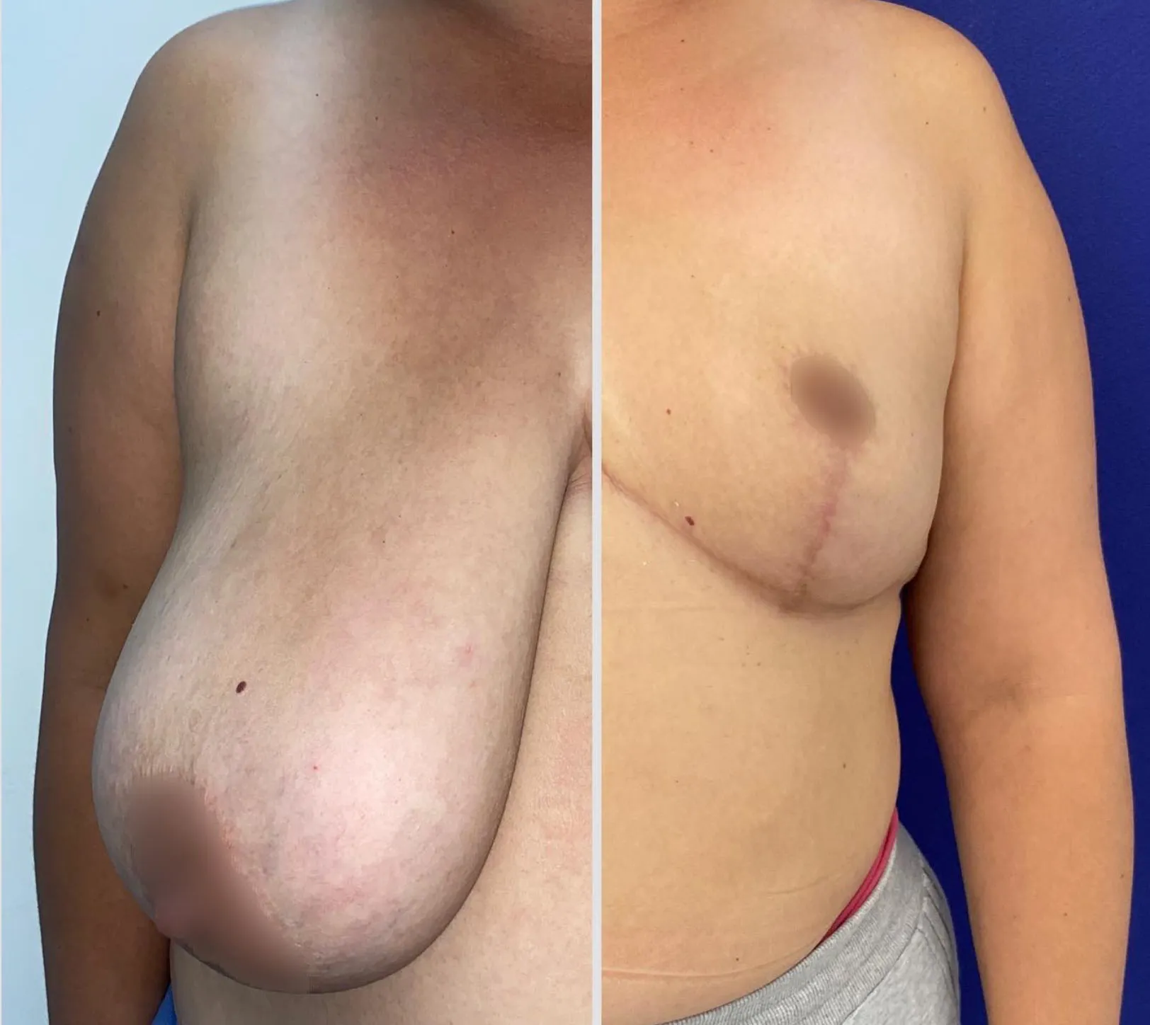 Gigantomastia: cuando el tamaño del busto afecta tu salud y bienestar