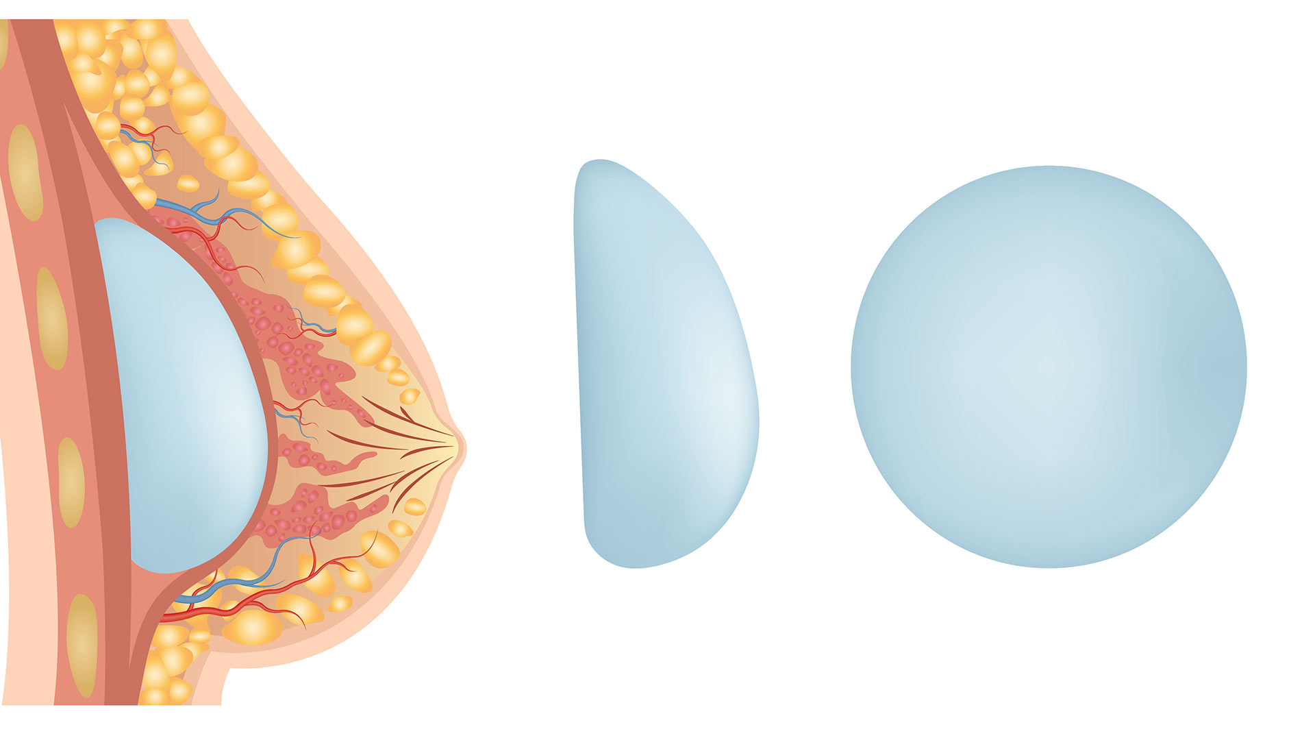 implantes mamarios con forma redonda